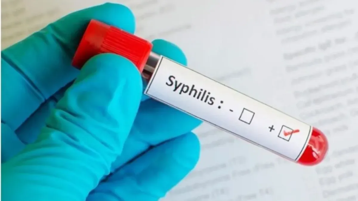 Alertan por el incremento de casos de sífilis en la Argentina
